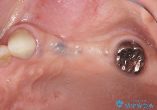 複数の奥歯の欠損 インプラントによる咬合機能回復の治療前
