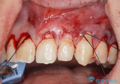 [ 根面被覆 ]  歯ぐきのさがりを改善、結合組織移植術の治療中