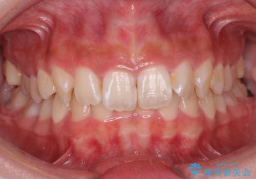 前歯の並び　インビザライン　非抜歯で　深いかみ合わせの治療の症例 治療前