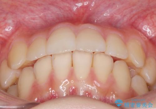 [ インビザラインライト ]    3.5ヶ月で行う前歯だけのマウスピース矯正の症例 治療後