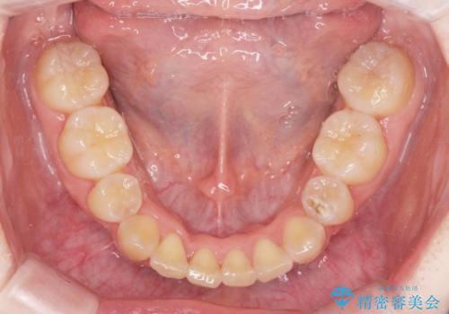 [ 八重歯を治す ]   小臼歯4本抜歯 マルチブラケット矯正の治療後