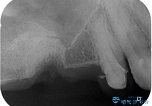 骨の造成を伴う奥歯のインプラント治療の治療前