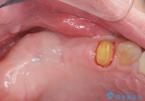 骨の造成を伴う奥歯のインプラント治療の治療中