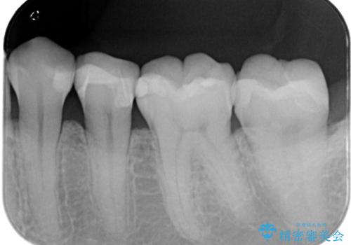 【セラミックインレー】口の中を白くしたいの治療後