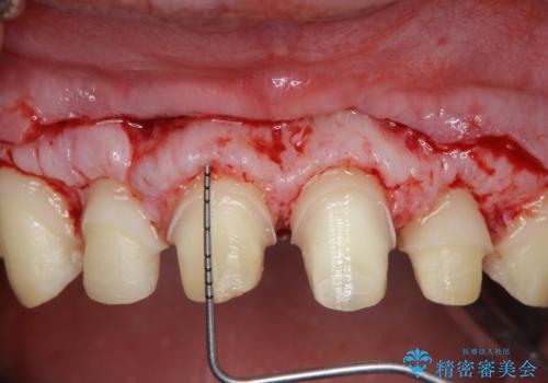 歯周外科を行い、歯ぐきの状態を整えた前歯セラミック治療の治療中