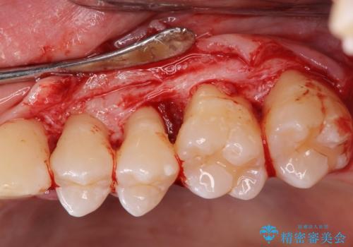 [ 歯周病 ]  歯槽骨の再生治療で歯を残すの治療中