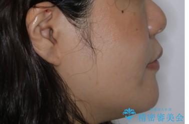 八重歯とクロスバイト:インビザライン治療の治療前(顔貌)