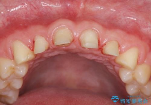 歯周外科を行い、歯ぐきの状態を整えた前歯セラミック治療の治療中