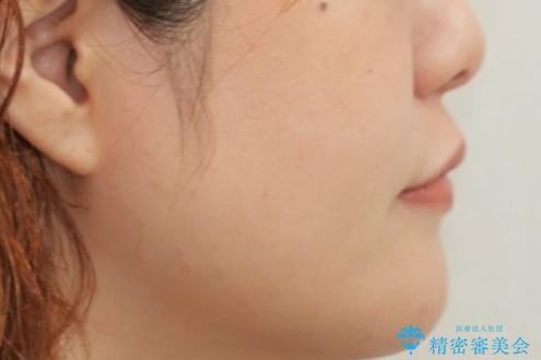 八重歯とクロスバイト:インビザライン治療の治療後(顔貌)