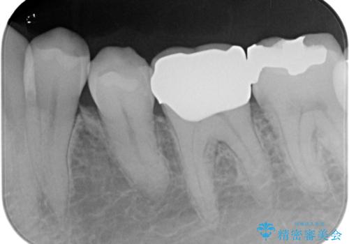 [銀歯の下が虫歯に] ジルコニアクラウンで修復の治療後
