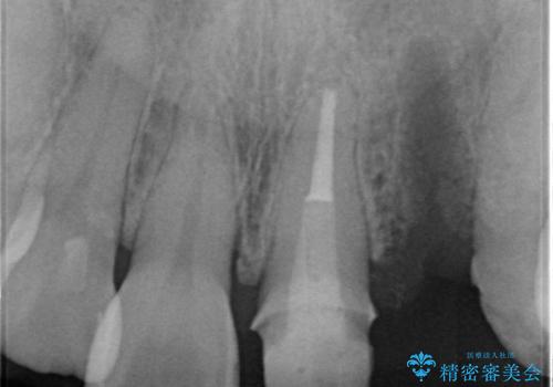 ぐらぐらする前歯 前歯のブリッジ治療の治療中