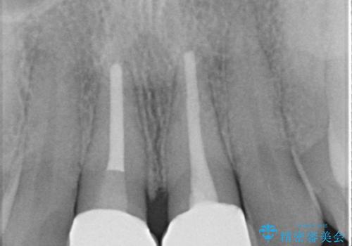 セラミッククラウンで前歯の変色を改善の治療後