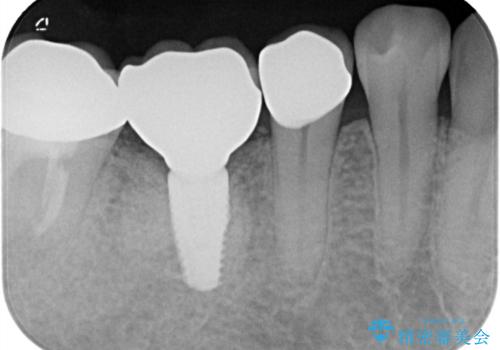 【オールセラミッククラウン】食事をしていたら歯が欠けた!の治療後