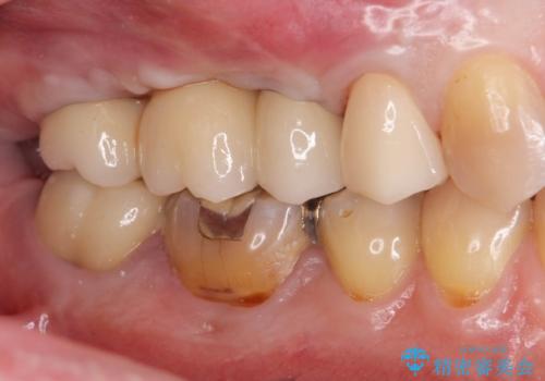 骨の造成を伴う奥歯のインプラント治療の治療後
