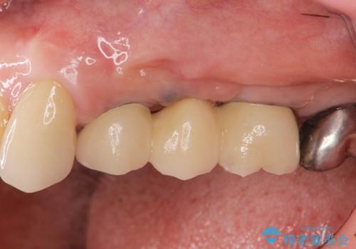 複数の奥歯の欠損 インプラントによる咬合機能回復の治療後