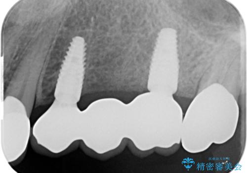 複数の奥歯の欠損　インプラントによる咬合機能回復の治療後