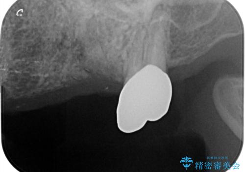 複数の奥歯の欠損　インプラントによる咬合機能回復の治療前