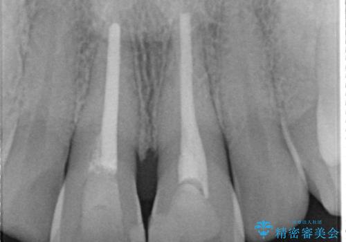 セラミッククラウンで前歯の変色を改善の治療前