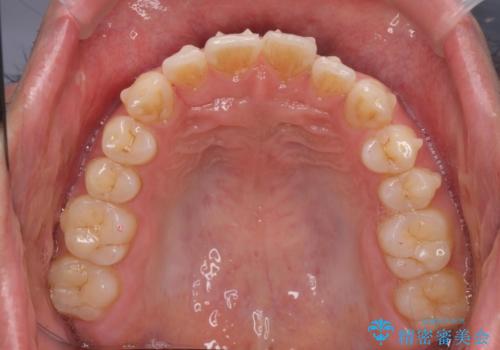 前歯が気になる。インビザラインライトの治療中