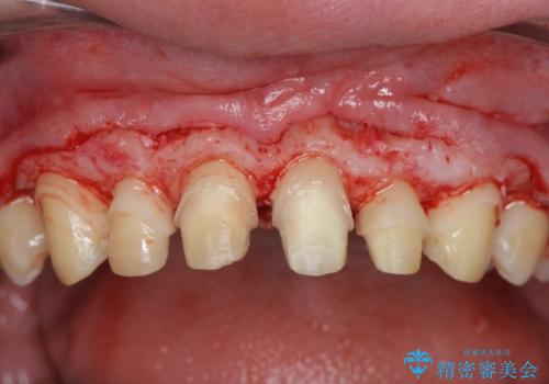 歯周外科を行い、歯ぐきの状態を整えた前歯セラミック治療の治療中