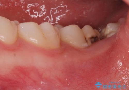 左奥歯が痛い。(親知らず抜歯 ジルコニアクラウン)の治療前