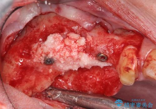 骨の造成を伴う奥歯のインプラント治療の治療中