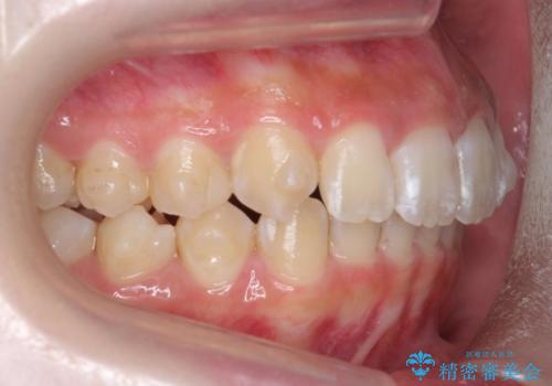 前歯の並び インビザライン 非抜歯で 深いかみ合わせの治療の治療中