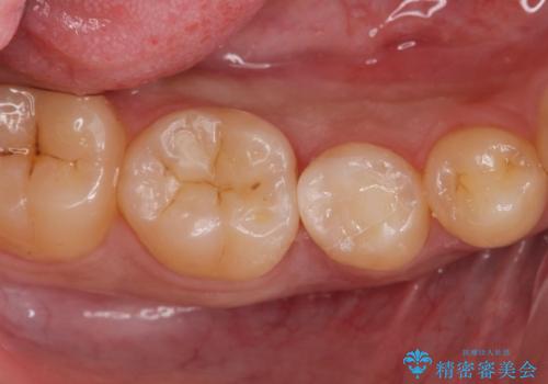 古い樹脂を除去してe-maxインレー
