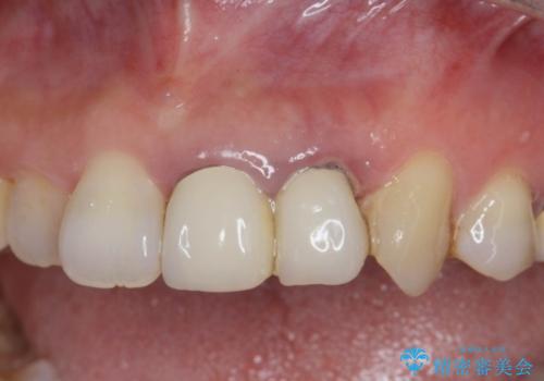 ぐらぐらする前歯 前歯のブリッジ治療の症例 治療前