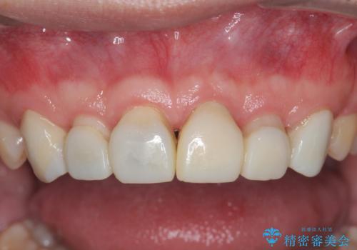 歯周外科を行い、歯ぐきの状態を整えた前歯セラミック治療の治療後