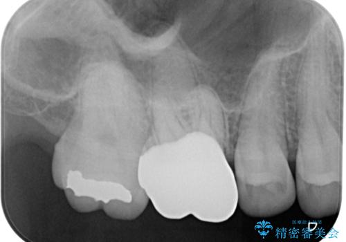 歯が割れた　オールセラミッククラウンの治療後
