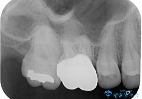 歯が割れた オールセラミッククラウンの治療後