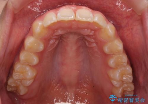 前歯の並び　インビザライン　非抜歯で　深いかみ合わせの治療の治療後