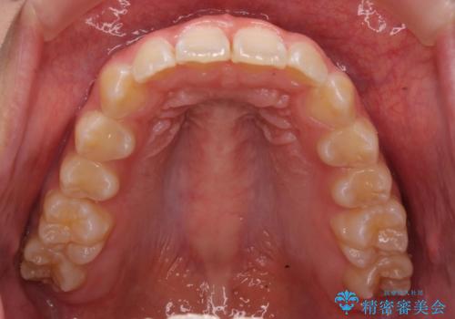 前歯の並び インビザライン 非抜歯で 深いかみ合わせの治療の治療後