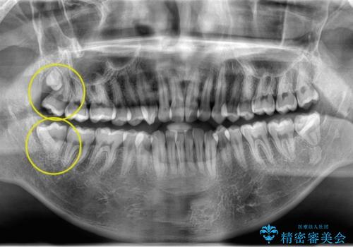 親知らず、過剰歯抜歯の抜歯の症例 治療前