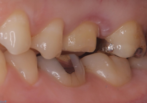 【セラミッククラウン】歯を白くしたいの治療中