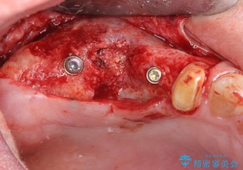 骨の造成を伴う奥歯のインプラント治療の治療中