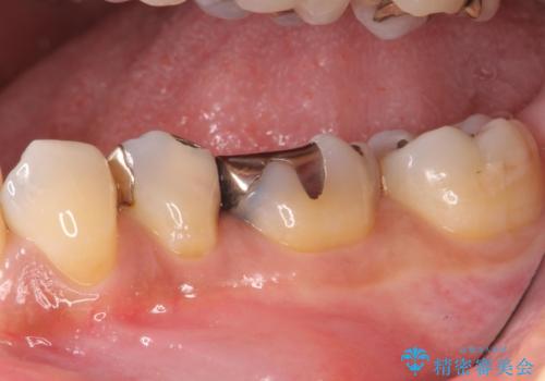 銀歯から精度の良い補綴物への治療前