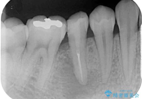 繰り返す痛み　下顎小臼歯の再根管治療の治療前