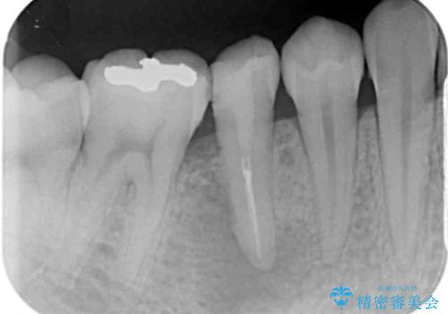 繰り返す痛み 下顎小臼歯の再根管治療の治療前