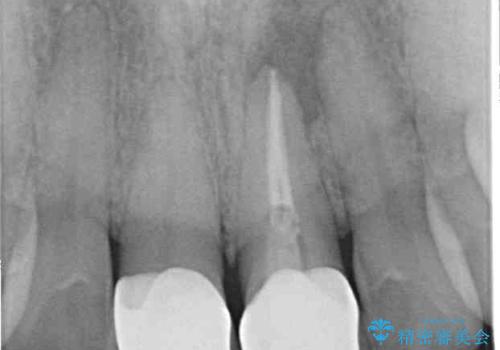 膿の出口が気になるセラミッククラウンの前歯　歯根端切除術で解決の治療前