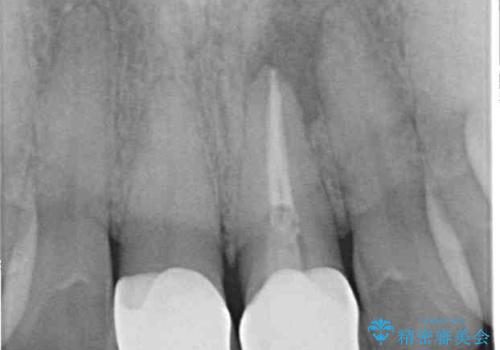 膿の出口が気になるセラミッククラウンの前歯 歯根端切除術で解決の症例 治療前