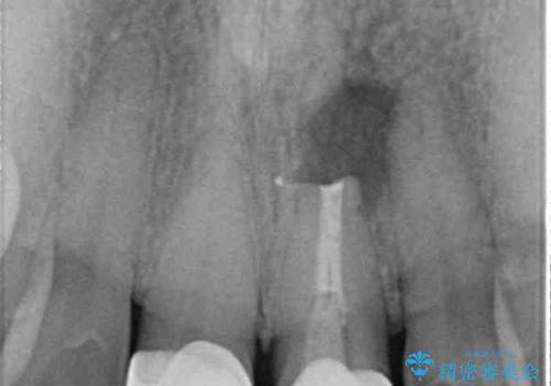 膿の出口が気になるセラミッククラウンの前歯　歯根端切除術で解決の治療中