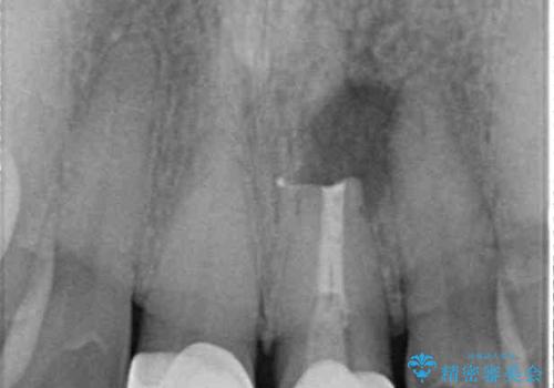 膿の出口が気になるセラミッククラウンの前歯 歯根端切除術で解決の治療中