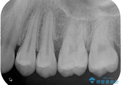 [ 歯周病 ]  歯槽骨の再生治療で歯を残すの症例 治療前