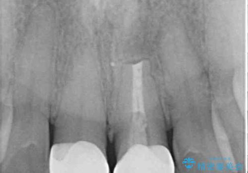 膿の出口が気になるセラミッククラウンの前歯　歯根端切除術で解決の治療後