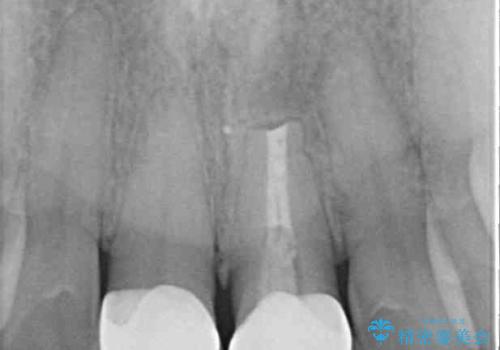 膿の出口が気になるセラミッククラウンの前歯 歯根端切除術で解決の症例 治療後