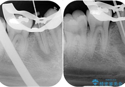 繰り返す痛み　下顎小臼歯の再根管治療の治療中