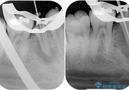繰り返す痛み 下顎小臼歯の再根管治療の治療中