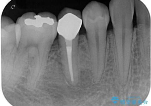 繰り返す痛み 下顎小臼歯の再根管治療の治療後